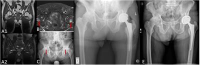 Osteoradionecrosis of the Hip, a Troublesome Complication of Radiation Therapy: Case Series and Systematic Review